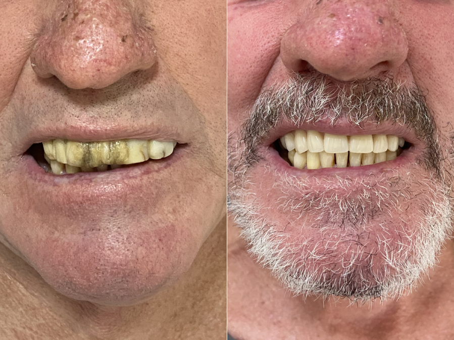 Resultado real de paciente com implante dentário na S&S Odontologia — antes e depois
